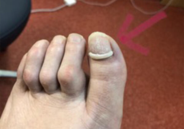 Onyfix Nail Correction