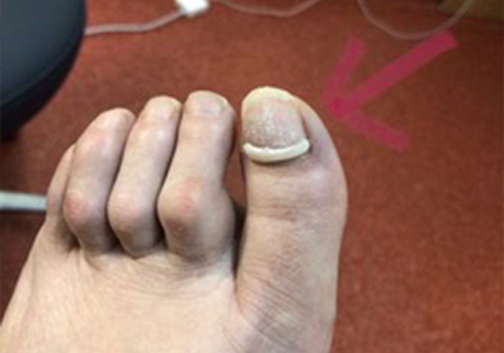 Onyfix Nail Correction