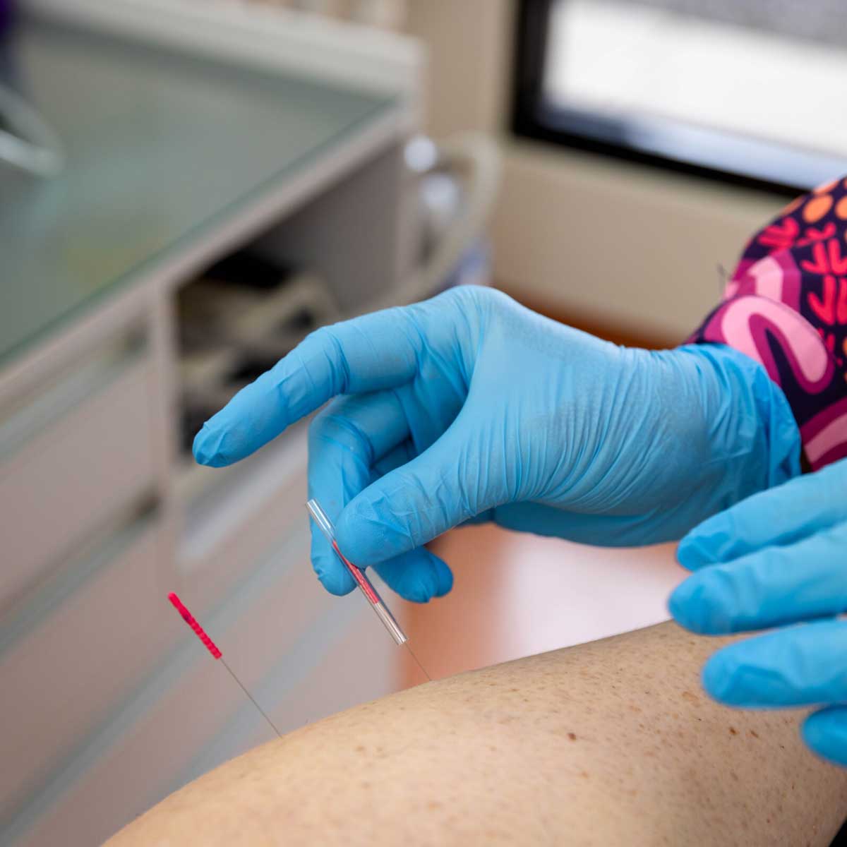 Close up of dry needling for heel pain and muscle release performed by Total Care Podiatry podiatrist in Geelong