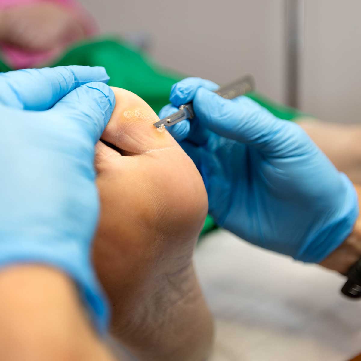 Corn removal and callus treatment by podiatrist at Total Care Podiatry in Geelong